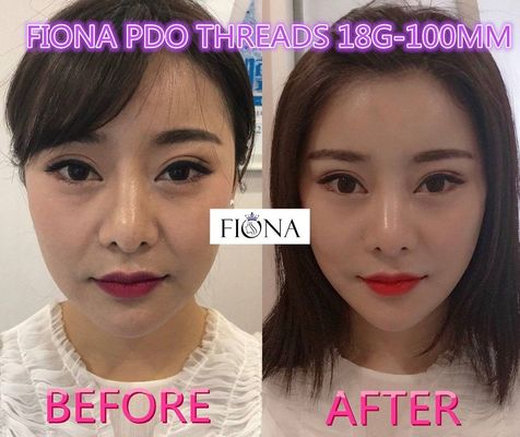 Fiona PDO und PCL-Faden, Faden des 38mm Facelift-PDO