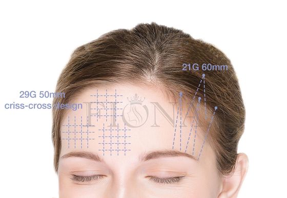 Zahn PLACL PCL PDO verlegt,/Stachelfaden für den Foxy Augen-Pferdeschwanz, der 360 4D 6D 12D anhebt