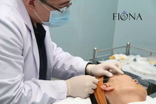 Nicht-chirurgischer Face lifting PDO PCL PLACL Zahn-Faden-Facelift 360 4D 6D 12D W Cannula