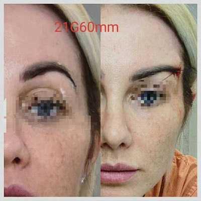 Zahn PLACL PCL PDO verlegt,/Stachelfaden für den Foxy Augen-Pferdeschwanz, der 360 4D 6D 12D anhebt