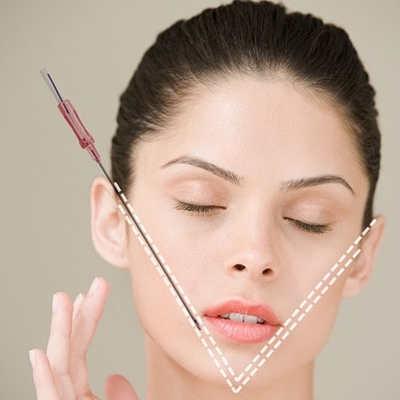 Nonsurgical PDO-Faden-Face lifting-Zahn-Faden 18G 100mm für sofortiges Face lifting